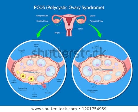 polycystic-ovary-syndrome-pcos-450w-1201754959