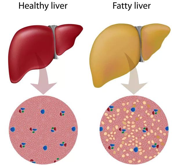 A healthy liver and fatty liver side by side